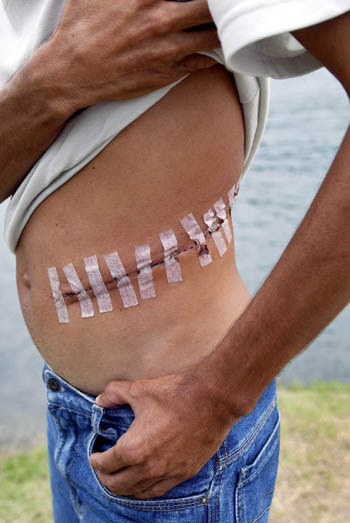 In this 2003 file photo, an unidentified Brazilian man shows the scar after an operation to remove his kidney in Durban, South Africa. An organ-trafficking syndicate involving Brazilians, Israelis and South Africans organized the illegal operations, with donors agreeing to sell their kidneys for $6,000 each. (CNS photo/Stringer, EPA) 